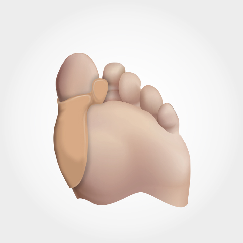 [831] TOE POST SPREADER WITH BUNION SHIELD